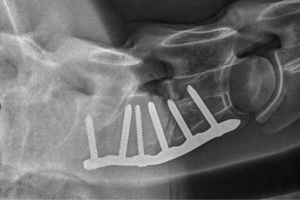 Röntgenbeeld van halswervels na halsoperatie en plaatsing locking-plate